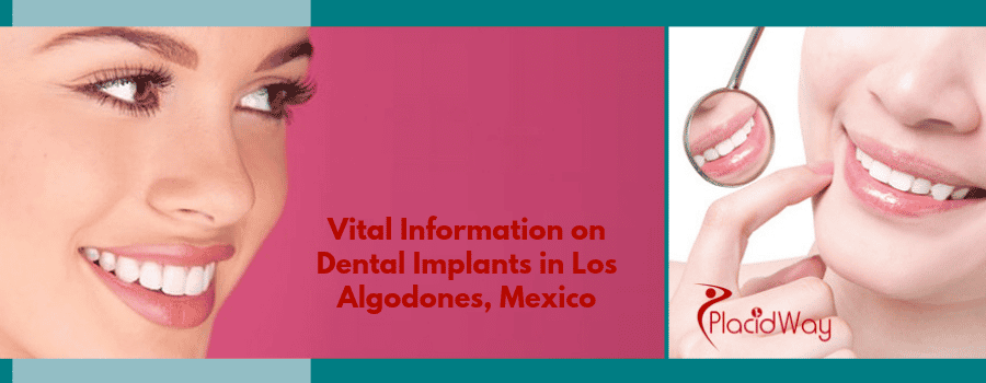 Dental Implants in Los Algodones, Mexico